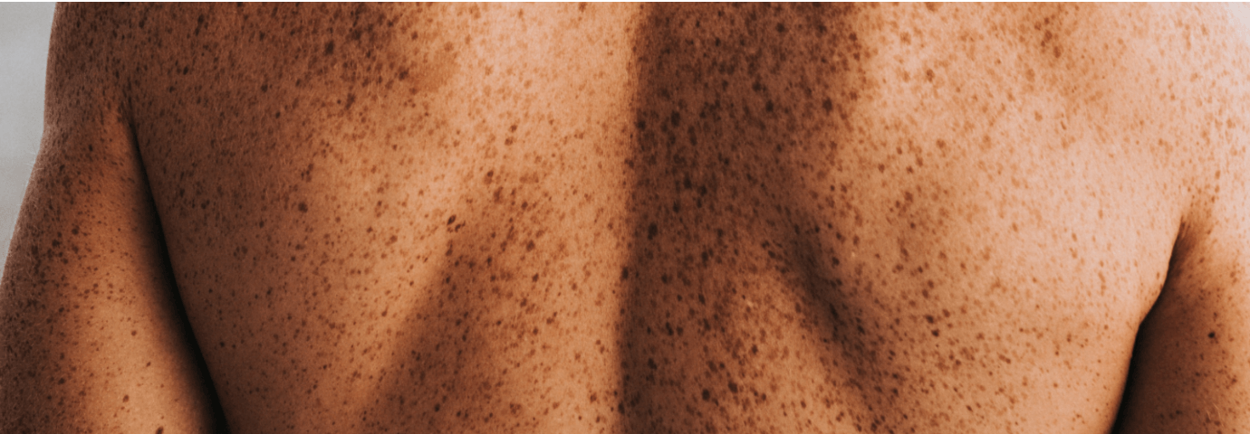 A back showing signs of pigmentation
